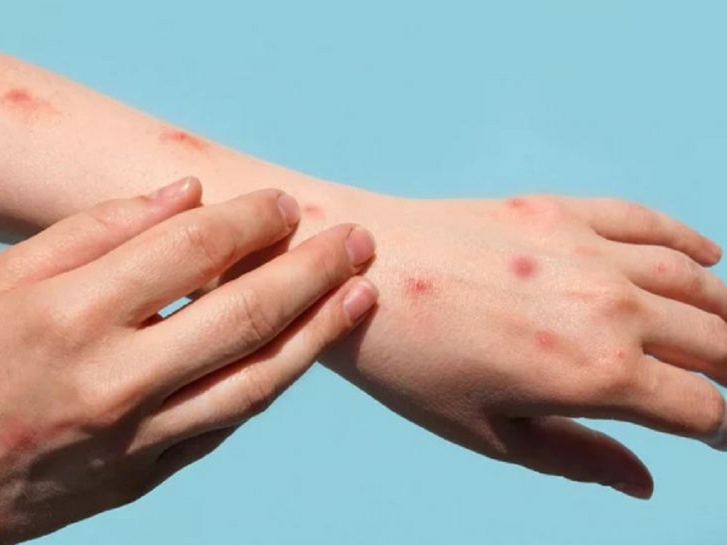 WHO: Kêu gọi châu Âu thực hiện hành động khẩn cấp bệnh đậu mùa khỉ WHO: Kêu gọi châu Âu thực hiện hành động khẩn cấp bệnh đậu mùa khỉ