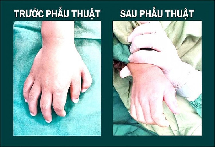 Trung tâm Y tế huyện Lâm Thao (Phú Thọ): Phẫu thuật thành công nhiều ca bệnh khó Trung tâm Y tế huyện Lâm Thao (Phú Thọ): Phẫu thuật thành công nhiều ca bệnh khó