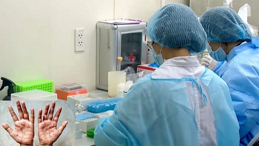 Vietnam will intensify research to produce drugs against monkeypox locally. Photo: VOV Vietnam will intensify research to produce drugs against monkeypox locally. Photo: VOV