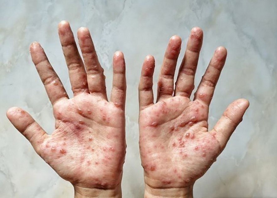Health Ministry Issues Monkeypox Monitoring Guidance Health Ministry Issues Monkeypox Monitoring Guidance