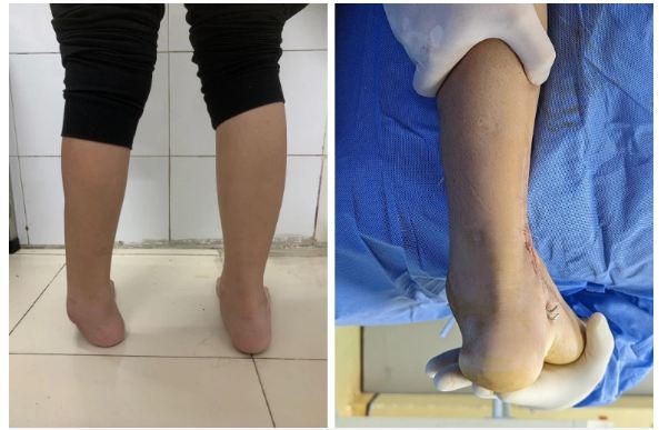 L.H.D patient's leg before and after surgery. Source: Saint Paul General Hospital L.H.D patient's leg before and after surgery. Source: Saint Paul General Hospital