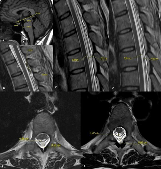 Hình ảnh MRI trước và sau thủ thuật vá máu ngoài màng cứng (EBP). Sau điều trị, khoang chứa dịch não tủy quanh tủy sống được mở rộng trở lại, trong khi khoang ngoài màng cứng thu hẹp rõ rệt. Những thay đổi này cho thấy áp lực dịch não tủy đã được cải thiện sau thủ thuật. Hình ảnh MRI trước và sau thủ thuật vá máu ngoài màng cứng (EBP). Sau điều trị, khoang chứa dịch não tủy quanh tủy sống được mở rộng trở lại, trong khi khoang ngoài màng cứng thu hẹp rõ rệt. Những thay đổi này cho thấy áp lực dịch não tủy đã được cải thiện sau thủ thuật.