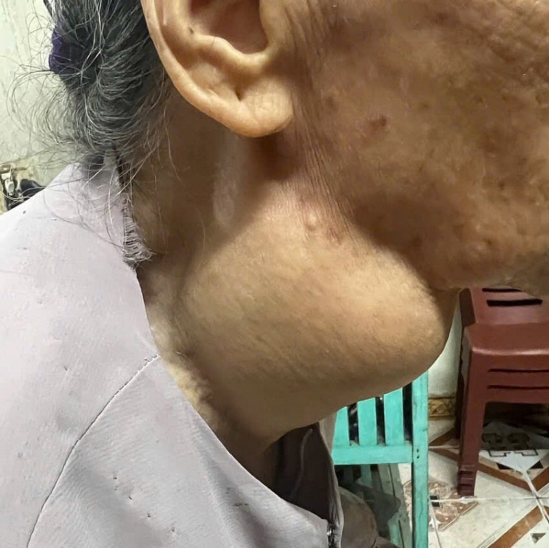 Vinmec Hạ Long giải cứu cụ bà 88 tuổi bị khối u giáp khổng lồ chèn ép đường thở suốt 18 năm