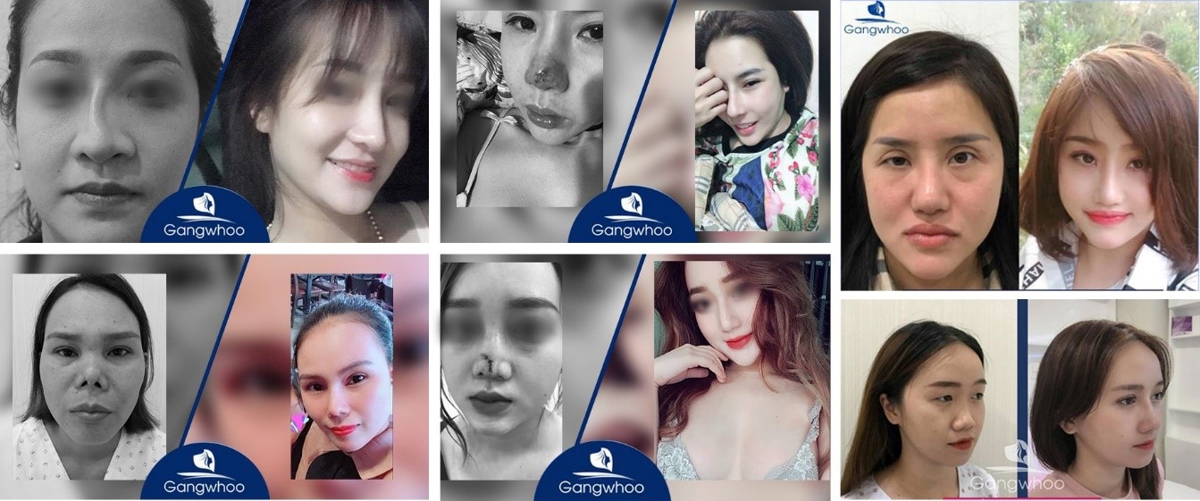 Thẩm mỹ viện Gangwhoo - Điểm làm đẹp uy tín tại Thành phố Hồ Chí Minh tham my vien gangwhoo diem lam dep uy tin tai thanh pho ho chi minh