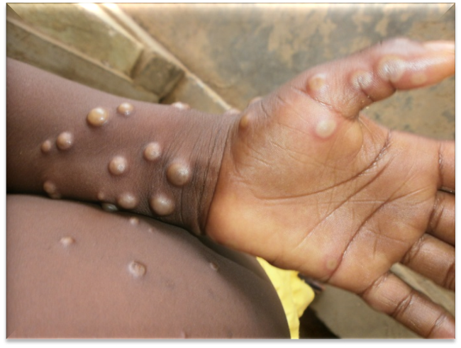 WHO cảnh báo virus gây bệnh đậu mùa khỉ tiếp tục lây lan WHO cảnh báo virus gây bệnh đậu mùa khỉ tiếp tục lây lan