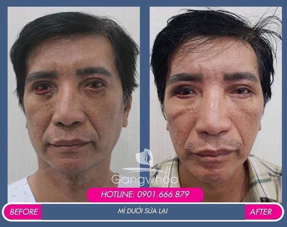Chú Lê Tuấn K. chia sẻ “sau 1 tháng, mắt tôi không những nhắm lại được mà nó còn đẹp hơn. Thật sự tôi rất đội ơn Gangwhoo” chu le tuan k chia se sau 1 thang mat toi khong nhung nham lai duoc ma no con dep hon that su toi rat doi on gangwhoo