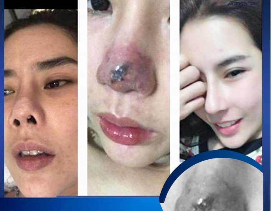 Hiện nay chiếc mũi của em đã hồi phục và em hoàn toàn hài lòng về dáng mũi của mìnhHiện nay chiếc mũi của em đã hồi phục và em hoàn toàn hài lòng về dáng mũi của mình. hien nay chiec mui cua em da hoi phuc va em hoan toan hai long ve dang mui cua minhhien nay chiec mui cua em da hoi phuc va em hoan toan hai long ve dang mui cua minh
