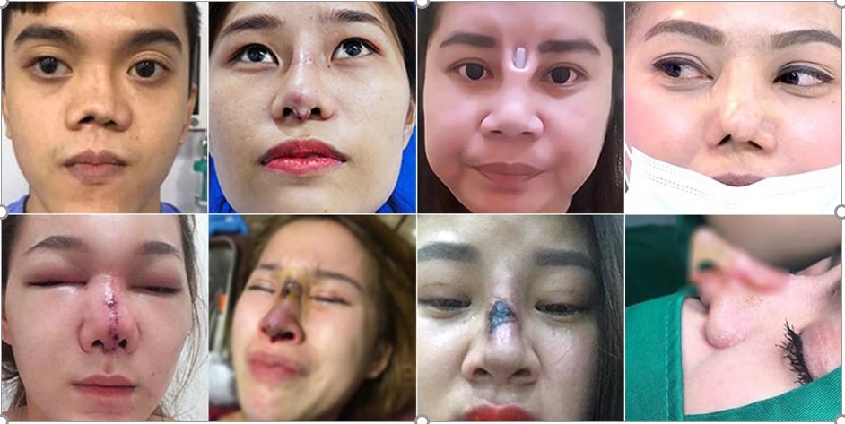Sau nâng mũi, cắt mí, khách hàng không được kết quả như lời PR trước đó, thậm chí khách hàng còn gặp phải tình hư hỏng nặng. sau nang mui cat mi khach hang khong duoc ket qua nhu loi pr truoc do tham chi khach hang con gap phai tinh hu hong nang