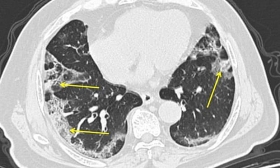 Coronavirus: what happens to people's lungs if they get Covid-19? coronavirus what happens to peoples lungs if they get covid 19