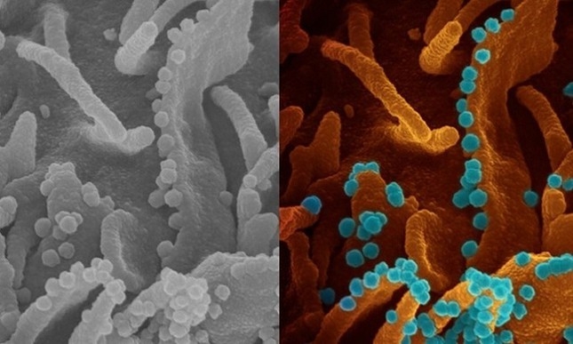 Ảnh tế bào virus SARS-CoV-2 chui ra từ tế bào sắp chết anh te bao virus sars cov 2 chui ra tu te bao sap chet