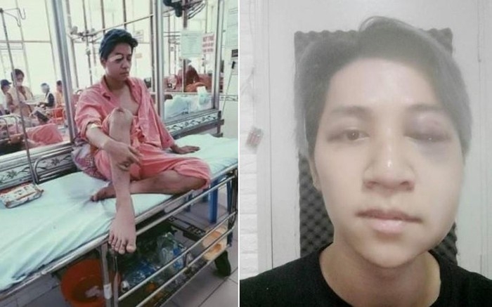 Bùi Duy Ngọc bị tai nạn nghiêm trọng, liệt nửa mặt và chấn thương não bui duy ngoc bi tai nan nghiem trong liet nua mat va chan thuong nao