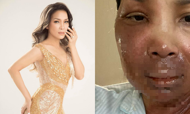 Hồng Ngọc đồng cảm với nỗi đau của gia đình bị bỏng vụ cháy phòng ngủ hong ngoc dong cam voi noi dau cua gia dinh bi bong vu chay phong ngu