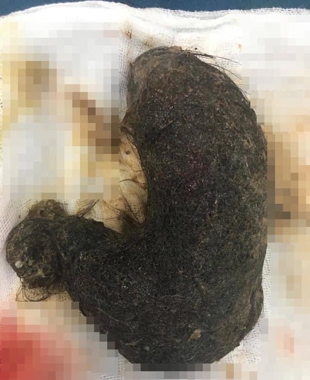 Huge hairball removed from 11 year-old’s stomach huge hairball removed from 11 year olds stomach