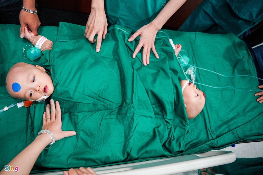 Nearly 100 doctors join in Vietnam’s most complicated co-joined twins separation Miracle of Vietnamese co-joined twins successfully separated after a 9-hour-surgery