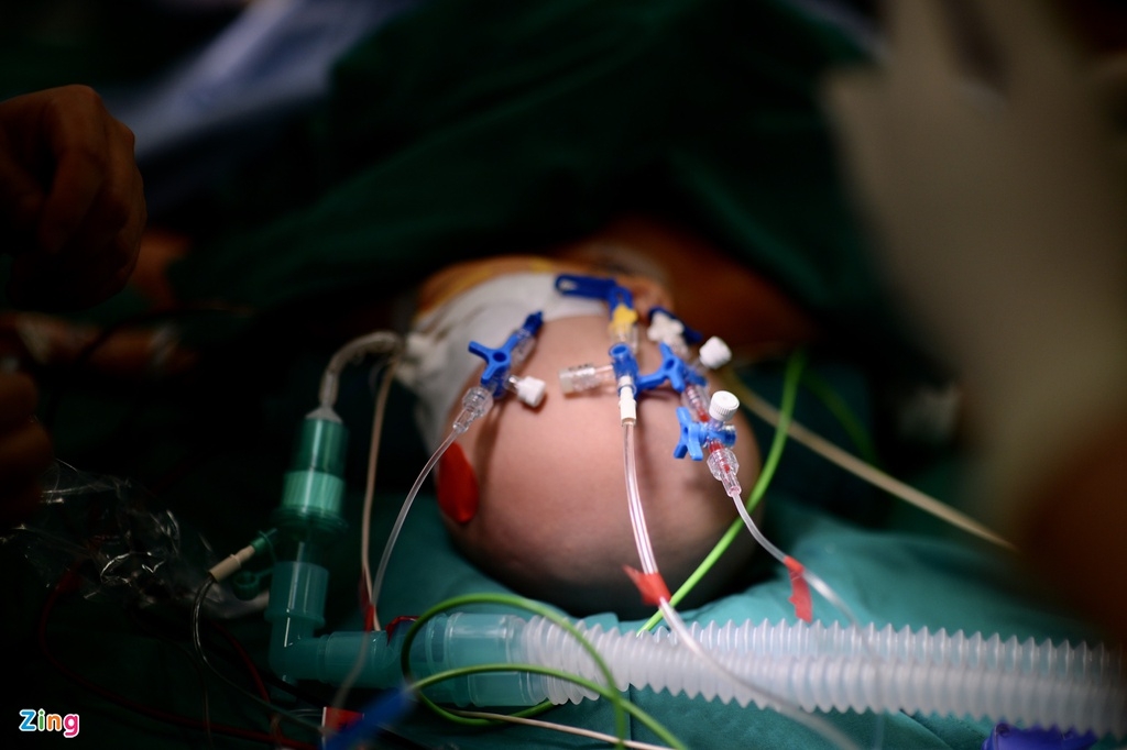 Nearly 100 doctors join in Vietnam’s most complicated co-joined twins separation Miracle of Vietnamese co-joined twins successfully separated after a 9-hour-surgery