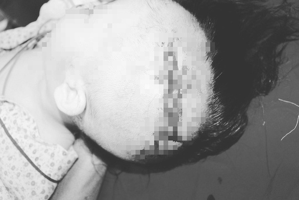 Hà Nội: Bé gái 2 tuổi bị chó nuôi cắn rách mặt, lộ xương sọ ha noi be gai 2 tuoi bi cho nuoi can rach mat lo xuong so