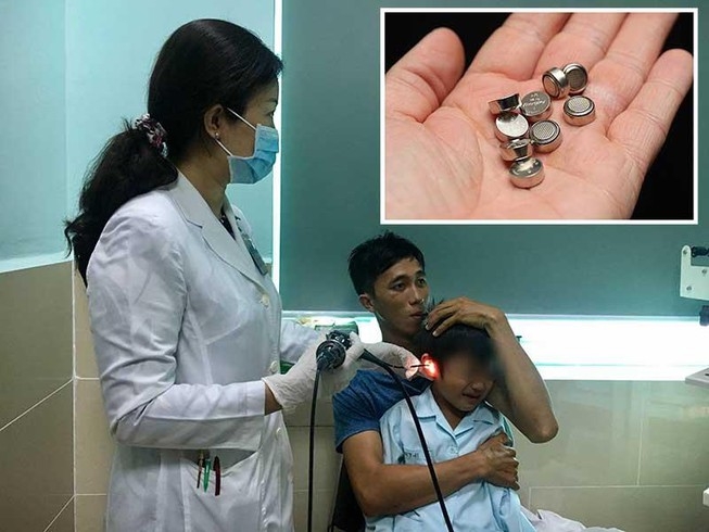 Nhét pin điện tử vào tai, bé trai 5 tuổi bị thủng màng nhĩ nhet pin dien tu vao tai be trai 5 tuoi bi thung mang nhi