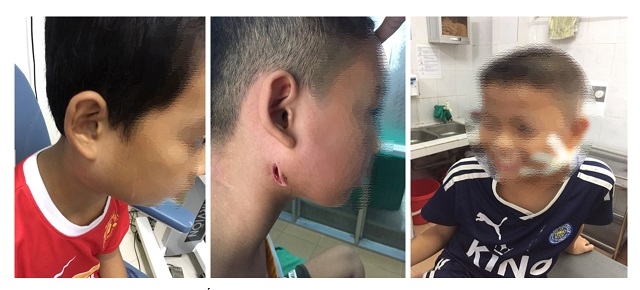 Phát hiện 3 trẻ nhiễm "vi khuẩn ăn thịt người" ở Nghệ An phat hien 3 tre nhiem vi khuan an thit nguoi o nghe an