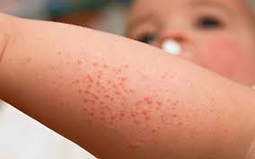 nhung benh do virus gay ra cho tre vao mua thu bo me can dac biet luu y