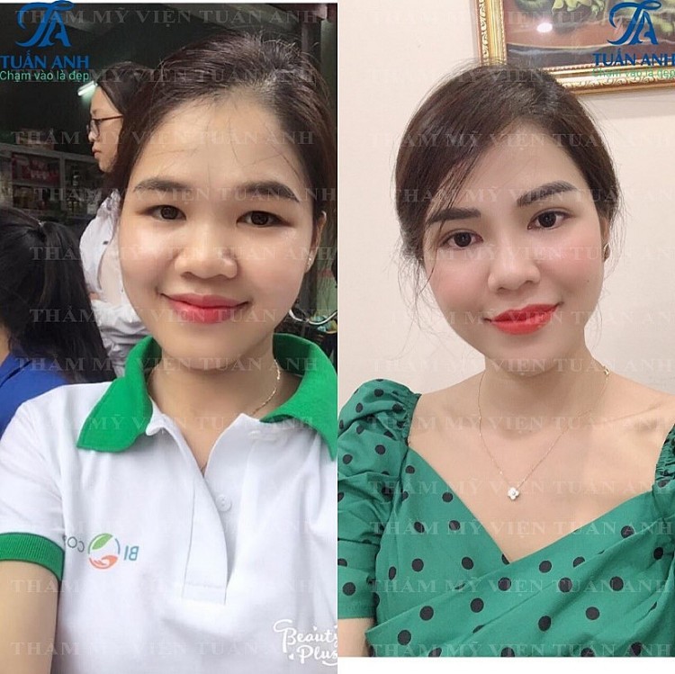 Sau phẫu thuật cắt mí và nâng mũi nhìn: gương mặt thay đổi rất nhiều ngũ quan cân đối và hài hòa hơn, đôi mắt tươi trẻ, nếp mí to rõ.