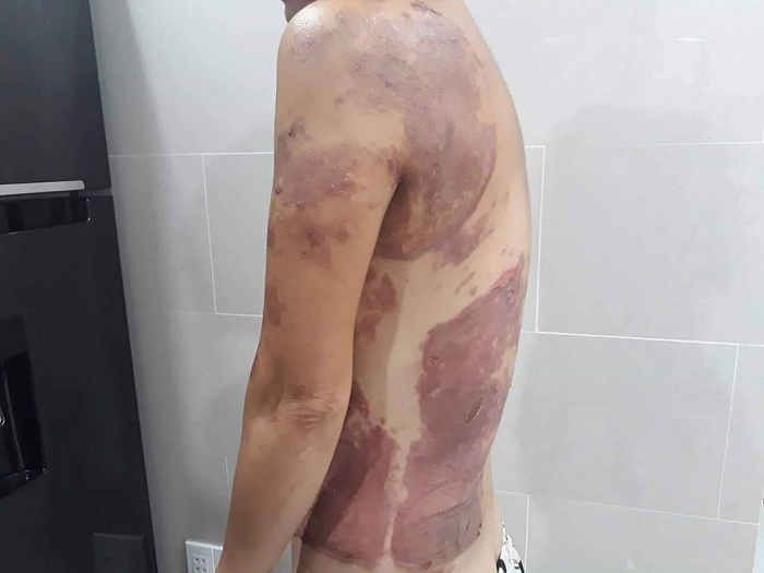 Nhắc nhở chuyện đậu ô tô, người phụ nữ bị hất chảo dầu sôi vào người ở TP.HCM nhac nho chuyen dau o to nguoi phu nu bi hat chao dau soi vao nguoi o tphcm