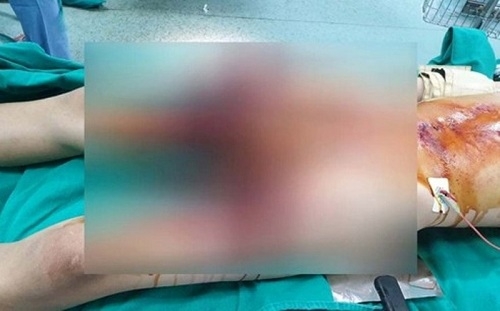 Thanh Hóa: Tự học làm pháo, nam sinh 13 tuổi bị nổ nát bàn tay thanh hoa tu hoc lam phao nam sinh 13 tuoi bi no nat ban tay