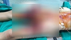 gia lai lam phao tu che bang bot diem nam sinh bi thuong nang