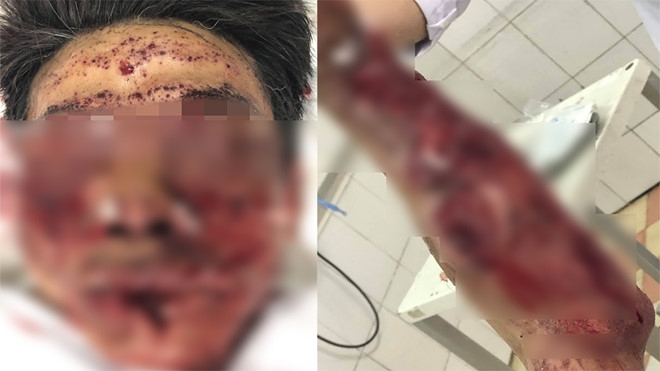 Hà Nam: Người đàn ông bị nổ nát mặt vì dùng pháo tự chế đón Tết ha nam nguoi dan ong bi no nat mat vi dung phao tu che don tet