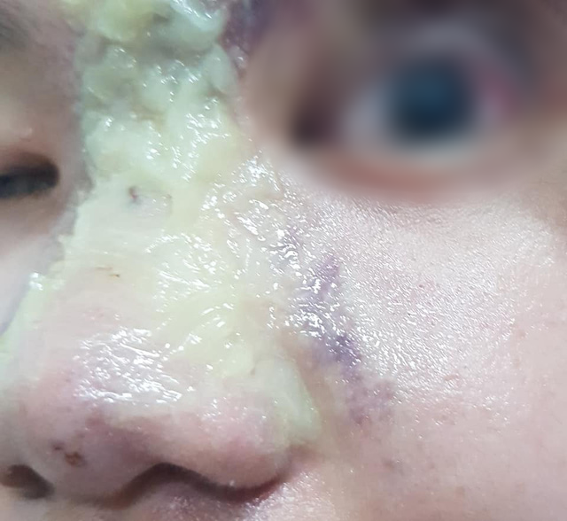 thieu nu 15 tuoi bi mu mat vinh vien sau tiem filler nang mui gia 15 trieu