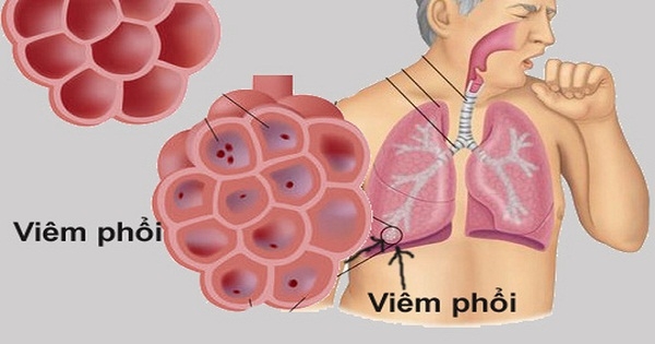 Viêm phổi do virus lạ ở Trung Quốc: Bộ Y tế khuyến cáo cách phòng, chống lây nhiễm viem phoi do virus la o trung quoc bo y te khuyen cao cach phong chong lay nhiem