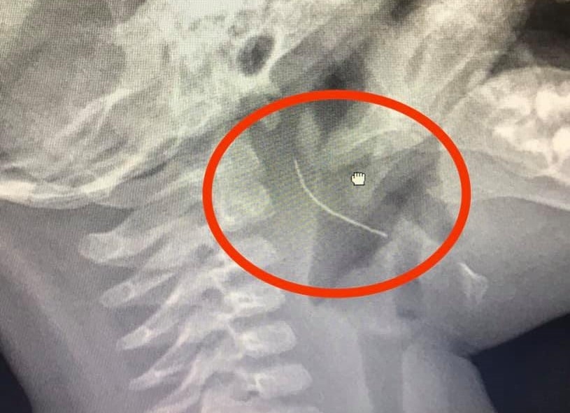 Ăn cháo lươn ngoài hàng, bé 13 tháng tuổi bị hóc… mảnh thép dài 2cm an chao luon ngoai hang be 13 thang tuoi bi hoc manh thep dai 2cm