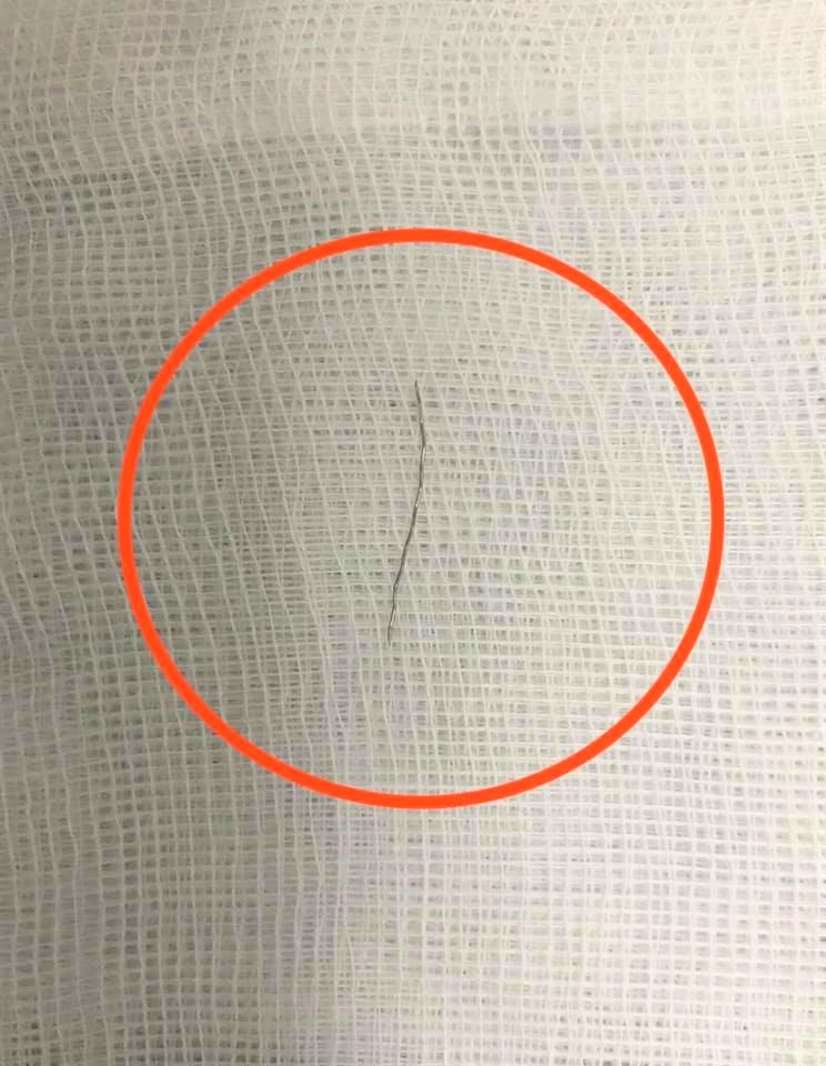 Ăn cháo lươn ngoài hàng, bé 13 tháng tuổi bị hóc… mảnh thép dài 2cm an chao luon ngoai hang be 13 thang tuoi bi hoc manh thep dai 2cm