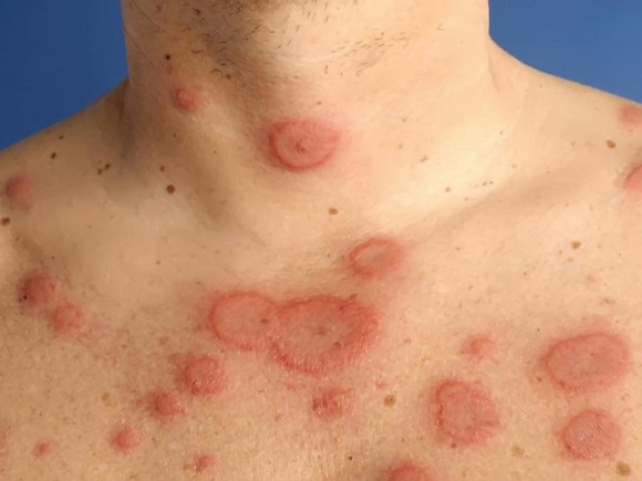 benh lupus ban do co nguy hiem khong trieu chung benh nhu the nao