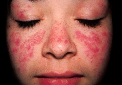 benh lupus ban do co nguy hiem khong trieu chung benh nhu the nao