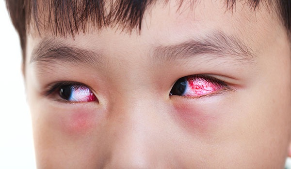 Miền Bắc nắng nóng kỷ lục, người dân dễ mắc phải những bệnh mùa hè gì? mien bac nang nong ky luc nguoi dan de mac phai nhung benh mua he gi