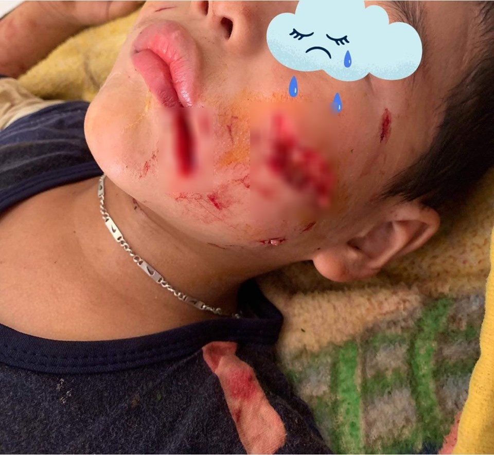 dam vao duoi cho be trai 5 tuoi bi can nat mat phai
