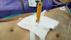 cuu song benh nhan bi chong dung dao dam thau nguc