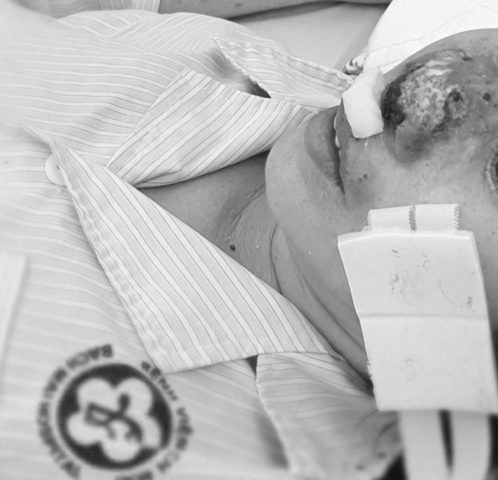 Bệnh whitmore có lây từ người sang người không? benh whitmore co lay tu nguoi sang nguoi khong