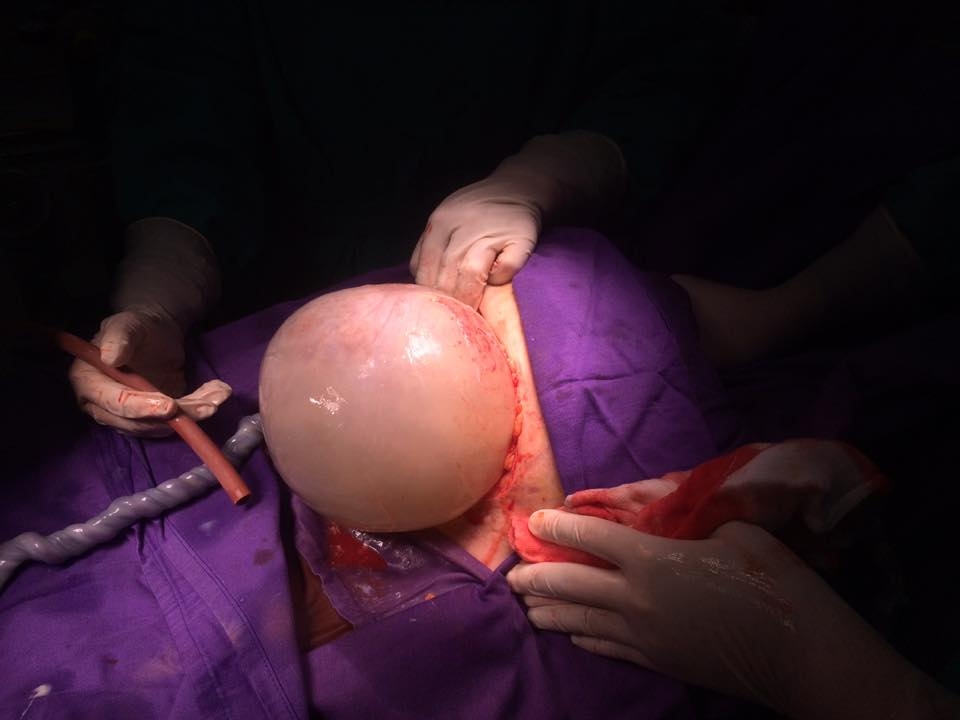 Cận cảnh cặp sinh đôi chào đời còn nguyên trong bọc ối can canh cap sinh doi chao doi con nguyen trong boc oi