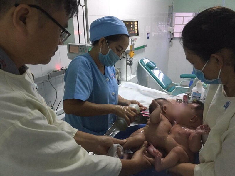 Cận cảnh ca phẫu thuật tách rời cặp sinh đôi dính liền bụng hơn 1 tháng tuổi can canh ca phau thuat tach roi cap sinh doi dinh lien bung hon 1 thang tuoi