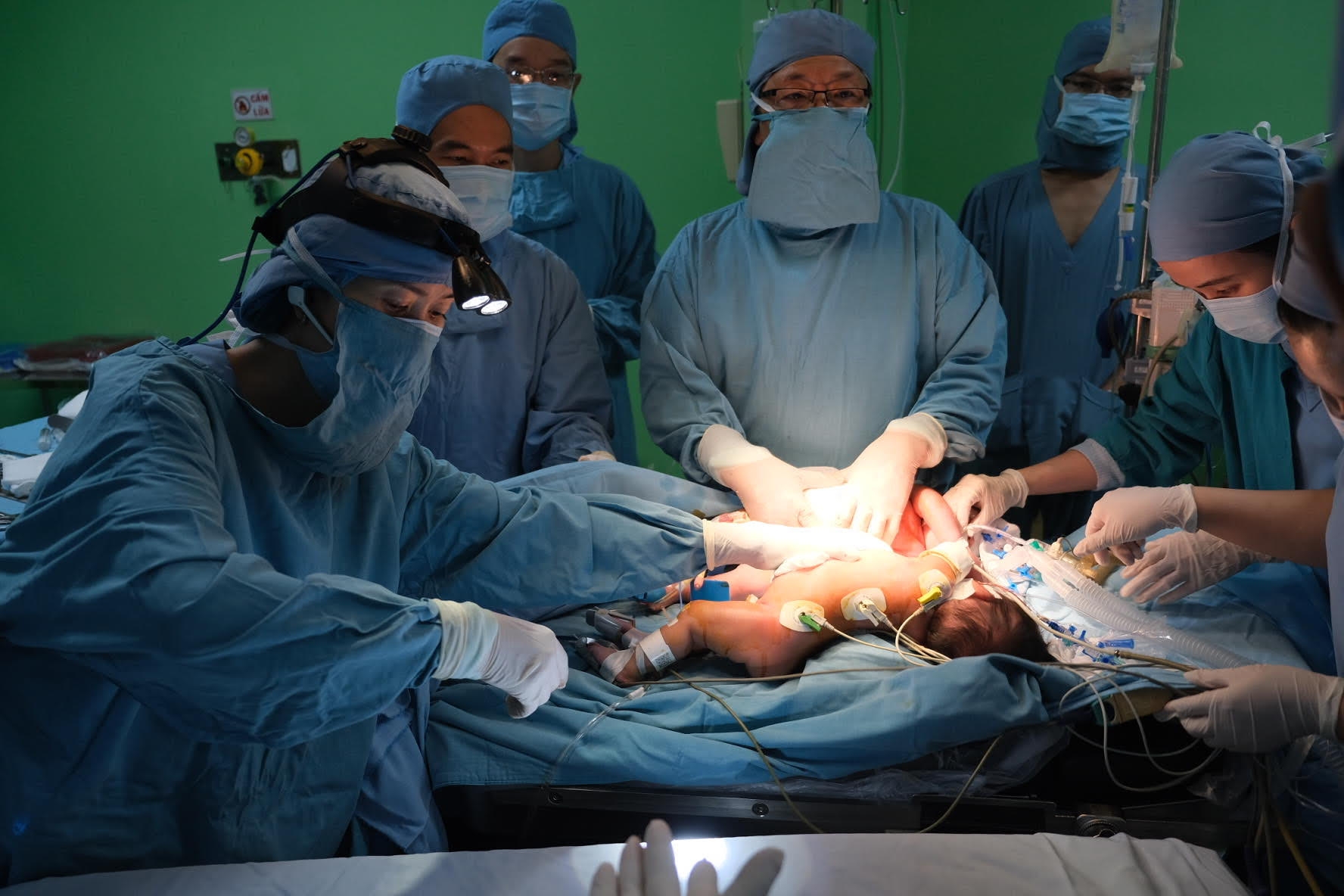 Cận cảnh ca phẫu thuật tách rời cặp sinh đôi dính liền bụng hơn 1 tháng tuổi can canh ca phau thuat tach roi cap sinh doi dinh lien bung hon 1 thang tuoi