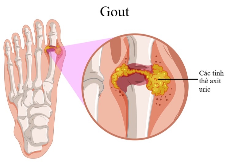 Người bị bệnh gút kiêng ăn gì để nhanh khỏi? nguoi bi benh gut kieng an gi de nhanh khoi
