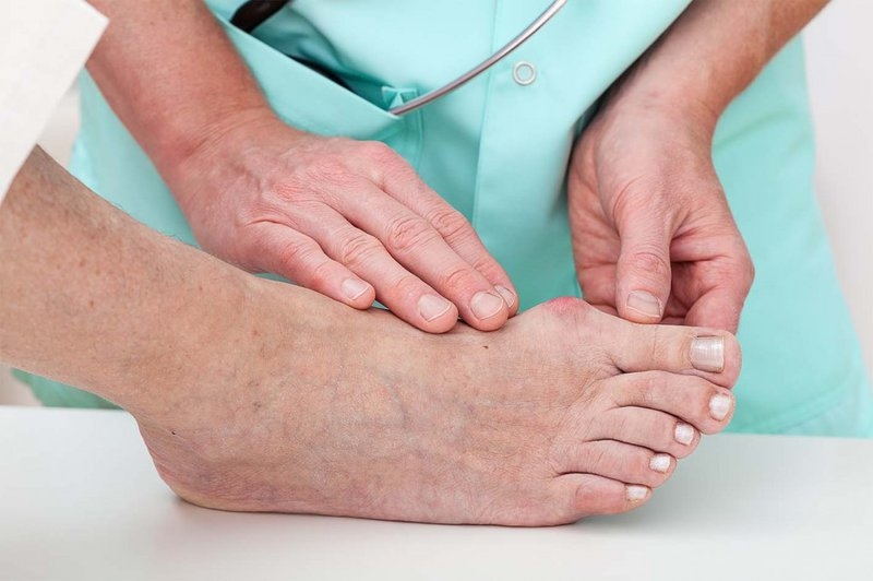 Người bị bệnh gút kiêng ăn gì để nhanh khỏi? nguoi bi benh gut kieng an gi de nhanh khoi