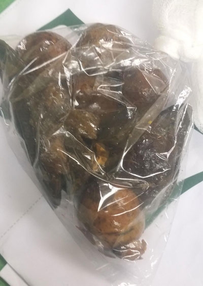 Bị tâm thần phân liệt, bệnh nhân cấp cứu vì nuốt hột xoài, quả chanh leo bi tam than phan liet benh nhan cap cuu vi nuot hot xoai qua chanh leo