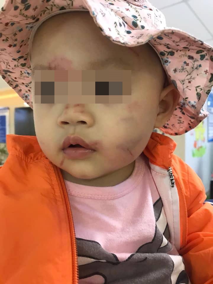 Bé 1 tuổi bầm tím mặt ở Hải Phòng: Kiểm điểm hai giáo viên be 1 tuoi bam tim mat may buoi dau di hoc o hai phong kiem diem hai giao vien