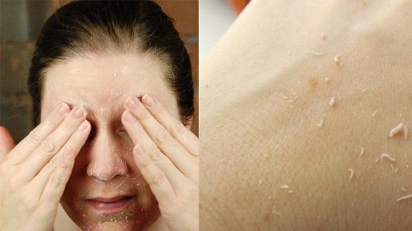 4 cách chăm sóc da mùa đông không nổi mụn, nứt nẻ 4 cach cham soc da mua dong khong noi mun nut ne