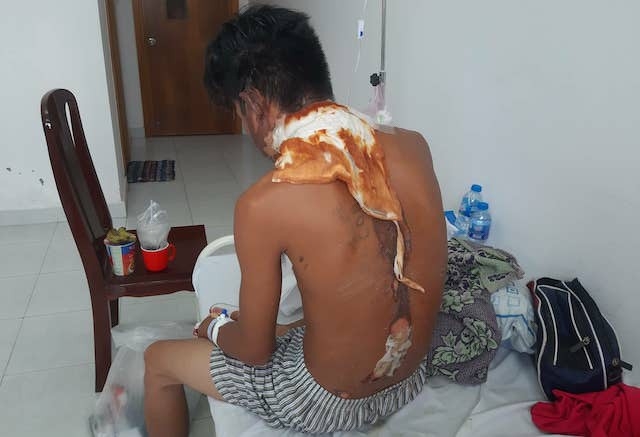 Đang ăn mì tôm, thanh niên bị chị ruột tưới nước sôi vào đầu dang an mi tom thanh nien bi chi ruot tuoi nuoc soi vao dau