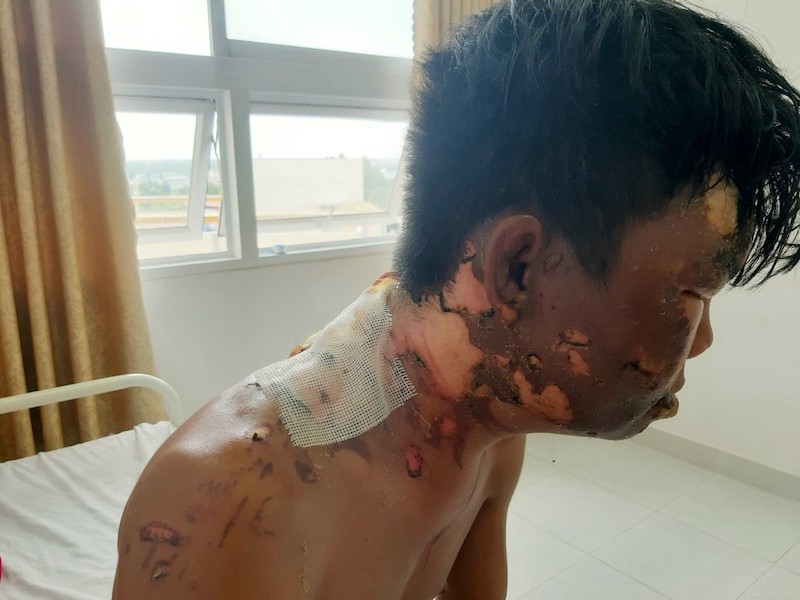 Đang ăn mì tôm, thanh niên bị chị ruột tưới nước sôi vào đầu dang an mi tom thanh nien bi chi ruot tuoi nuoc soi vao dau