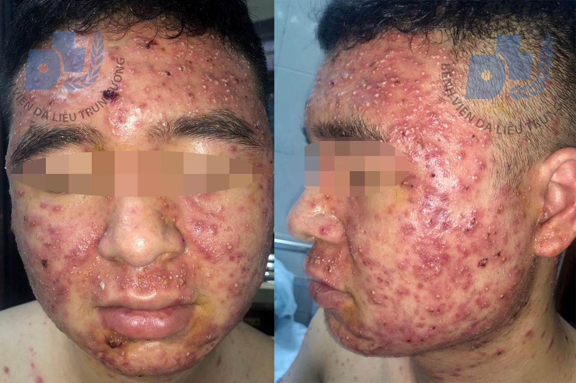Trị mụn trứng cá bằng thuốc nam, thanh niên bị mủ lan khắp mặt tri mun trung ca bang thuoc nam thanh nien bi mun mu lan khap mat