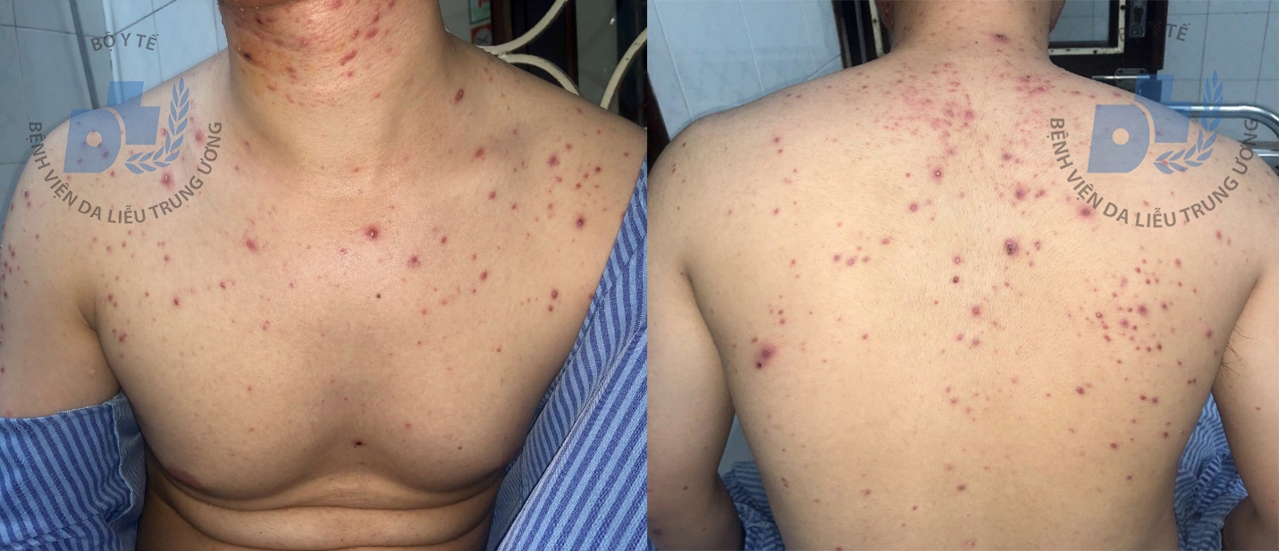 Trị mụn trứng cá bằng thuốc nam, thanh niên bị mủ lan khắp mặt tri mun trung ca bang thuoc nam thanh nien bi mun mu lan khap mat